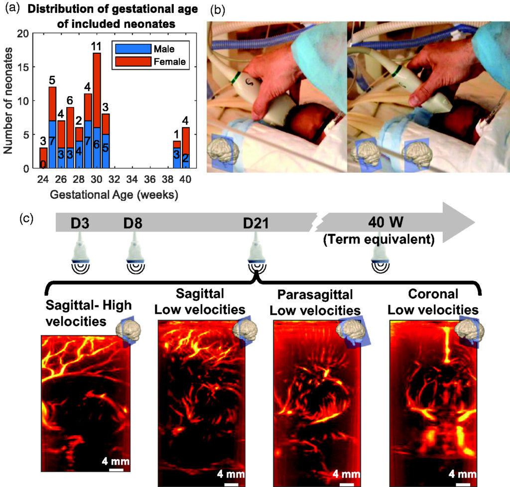 Quantification of brain-wide vascular resistivity via ultrafast Doppler